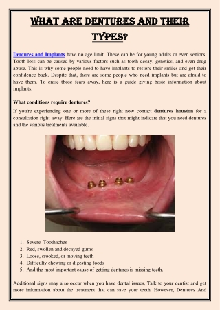 What are Dentures and Their Types