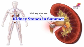 Kidney Stones in Summer