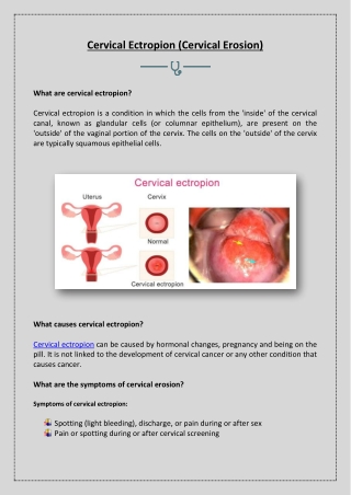 What are Cervical Ectropion?