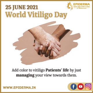 World Vitiligo Day 2021 | Best Dermatology Centre in Bangalore | Epiderma Clinic