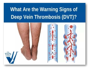 What Are The Most Common Signs Of DVT