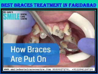 How Can I Get Best Braces Treatment and An Orthodontist in Faridabad?