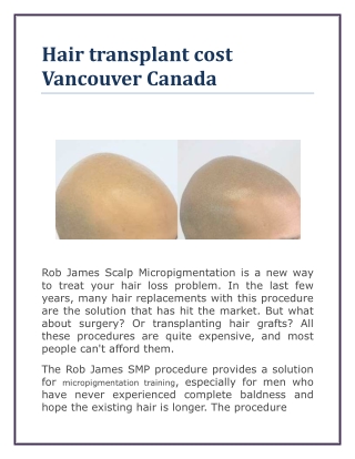 Hair transplant cost Vancouver Canada