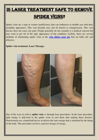 Is Laser Treatment Safe To Remove Spider Veins