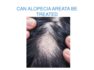 CAN ALOPECIA AREATA BE TREATED