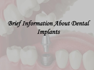 Brief Information About Dental Implants