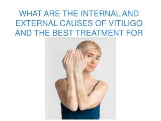 WHAT ARE THE INTERNAL AND EXTERNAL CAUSES OF VITILIGO AND THE BEST TREATMENT FOR VITILIGO