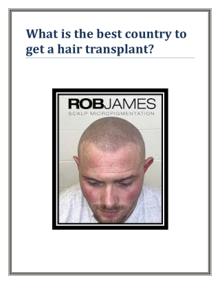 What is the best country to get a hair transplant?