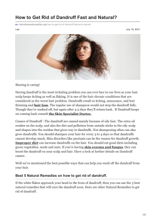 How to Get Rid of Dandruff Fast and Natural