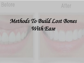 Methods To Build Lost Bones With Ease