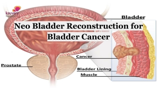 Neo Bladder Reconstruction for Bladder Cancer