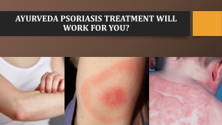 Ayurveda Psoriasis Treatment Will Work for You?