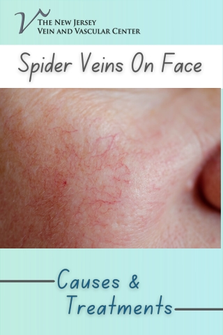 Spider Veins on Your Face: Causes and Treatment