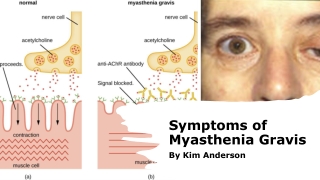 Myasthenia gravis