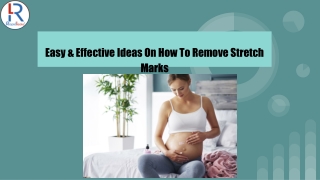 How To Remove Stretch Marks