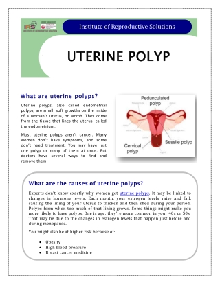 What are Uterine Polyps?
