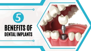 5 Benefits of Dental Implants