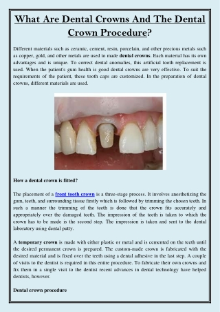 What are Dental Crowns and the Dental Crown Procedure