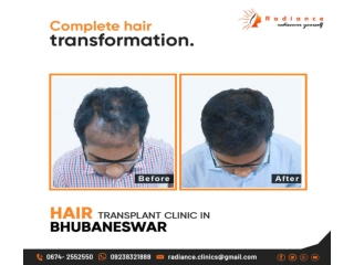 Hair Transplant in Odisha