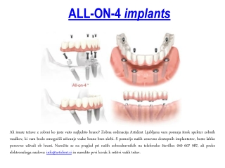 ALL-ON-4 implants