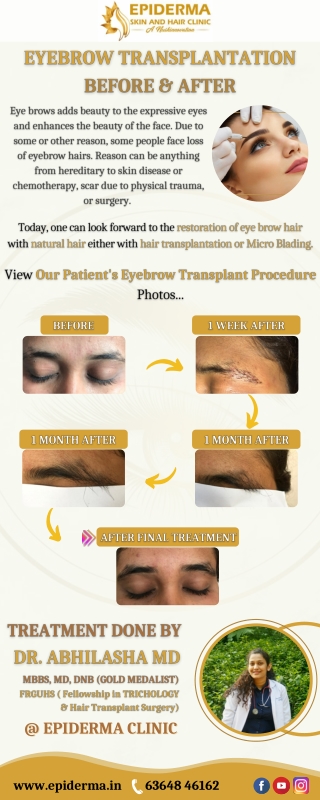 Eyebrow Transplantation Before and After - Eyebrow Transplantation in Bangalore