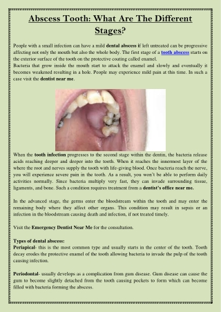 Abscess Tooth What Are The Different Stages