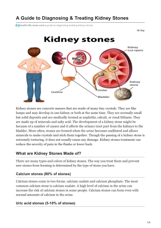health-life-news.com-A Guide to Diagnosing amp Treating Kidney Stones