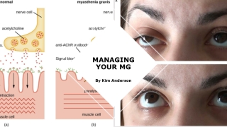 Myasthenia gravis