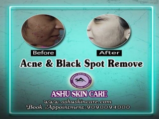 ashu skin care is one of the best acne and block spot treatment clinic in bhubaneswar, odisha.