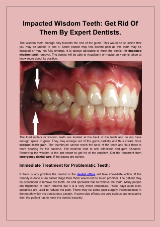 Impacted Wisdom Teeth Get Rid Of Them By Expert Dentists.