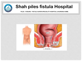 What Is Fistulotomy?