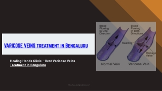 Best Varicose Veins Center in Bengaluru - Varicose Veins Hospital in Bengaluru