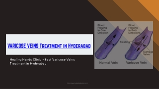 Varicose Veins Hospital in Hyderabad - Varicose Veins operation in Hyderabad