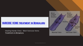 Varicose Veins Hospital in Bengaluru - Varicose Veins operation in Bengaluru