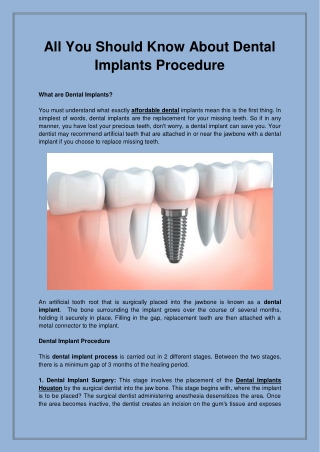 All You Should Know About Dental Implants Procedure