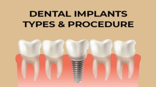 KNOW THE DENTAL IMPLANT TYPES AND PROCEDURE