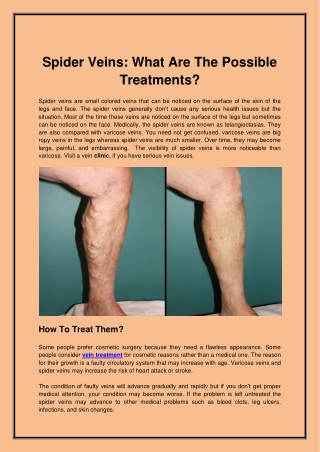 Spider Veins What Are The Possible Treatments