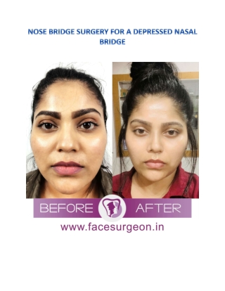 Nose Bridge Surgery for a depressed nasal bridge