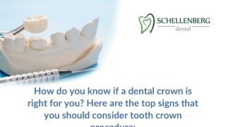 Signs You Need a Dental Crown - SchellenbergDental