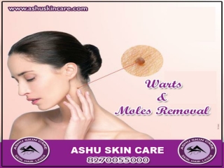 ashu skin care is best clinic for  wart and mole removal  in bhubaneswar, odisha.