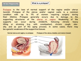Prolapse Treatment in Surrey