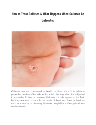 How to Treat Calluses & What Happens When Calluses Go Untreated