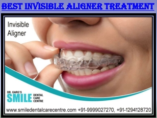 Best Invisible Aligner Treatment Available at Our Clinic