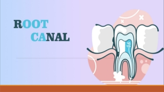 What Is Root Canal