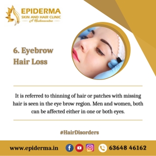 Eyebrow Hair Loss | Best Hair loss treatment in Bangalore | Epiderma Clinic