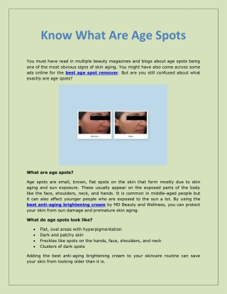 Know What Are Age Spots