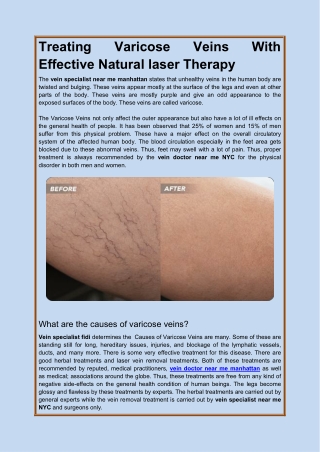 Treating Varicose Veins With Effective Natural laser Therapy