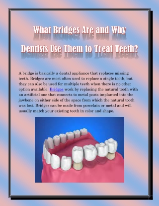 What Bridges Are and Why Dentists Use Them to Treat Teeth?