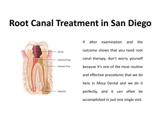 Root Canal Treatment in San Diego