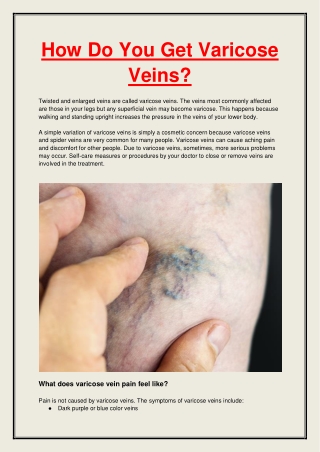 How Do You Get Varicose Veins